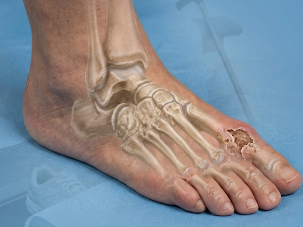 Foot Arthritis