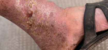 Gangrene