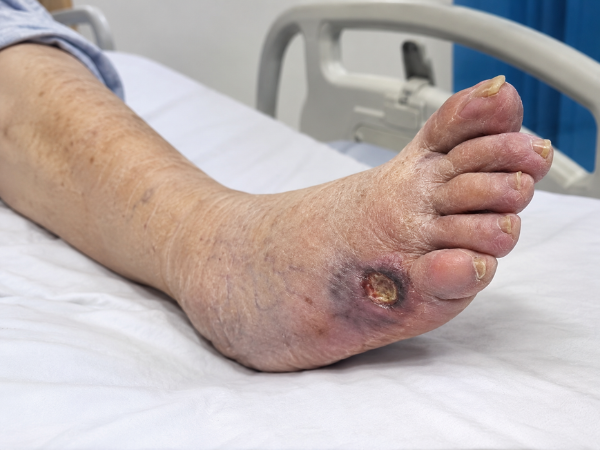 Ischemic Ulcer