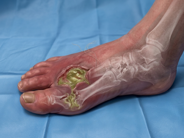 Osteomyelitis (Bone Infection)