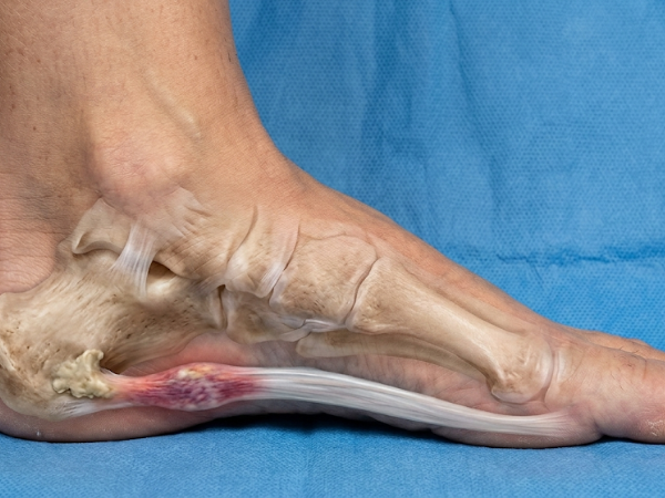 Plantar Fasciitis