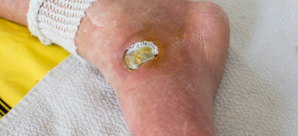 Diabetic Foot Ulcer